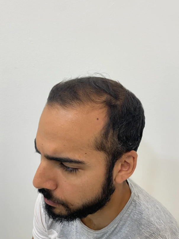 ANTES