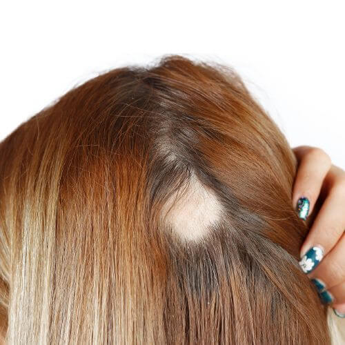 alopecia areata causas