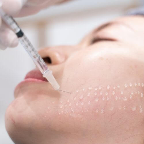 tipos de mesoterapia