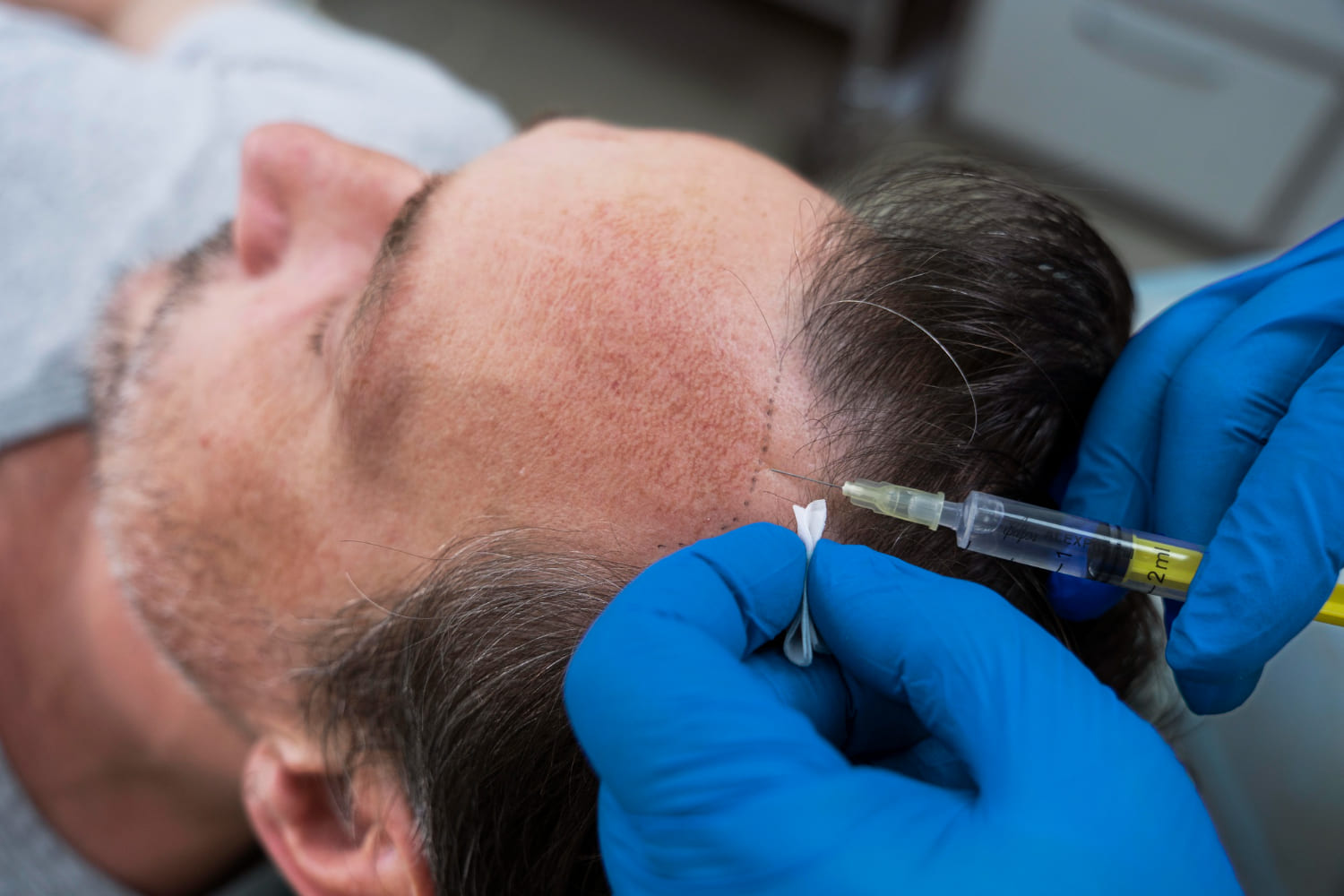 beneficios de la mesoterapia capilar