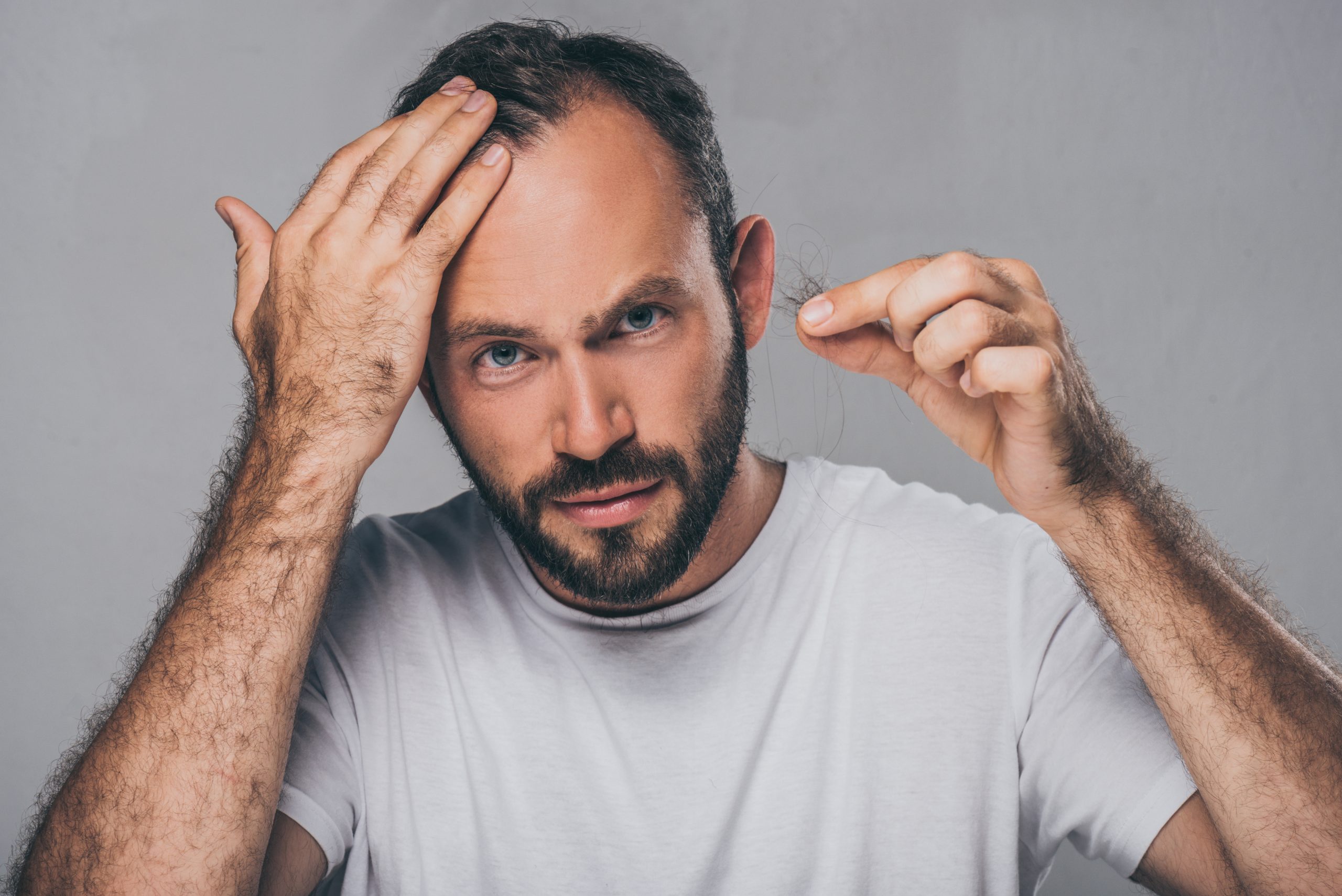 Qué es la alopecia androgénica