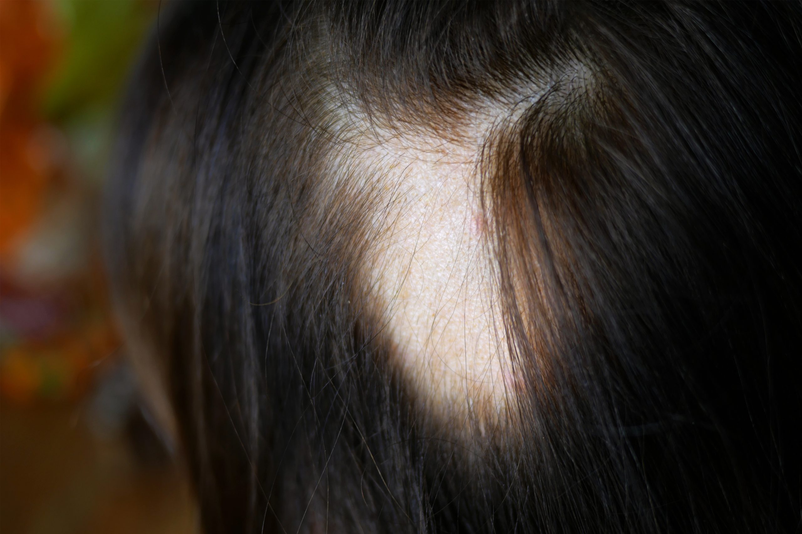 tipos de alopecia areata