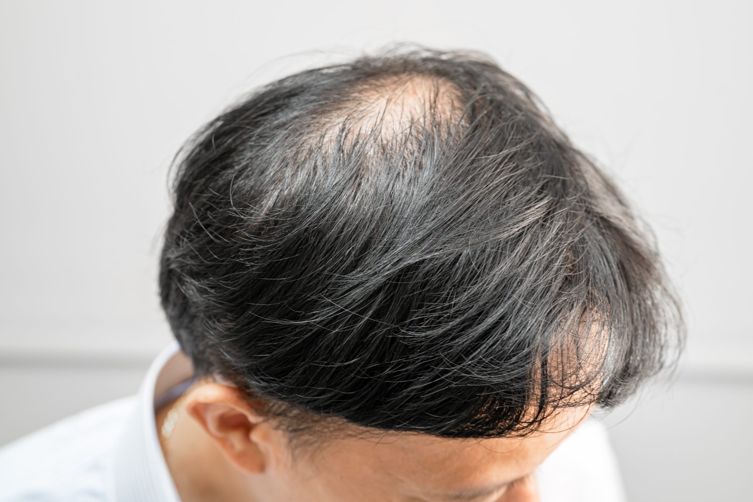 Cómo frenar la alopecia areata