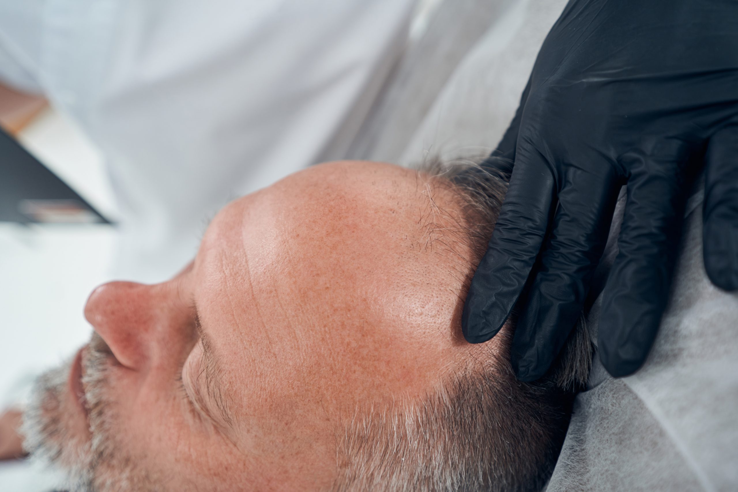 Alopecia cicatricial